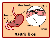 Gastric Ulcer